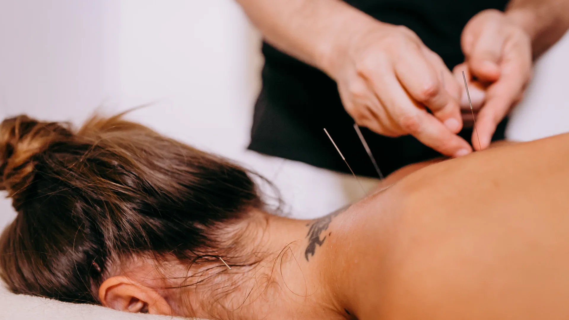 Thin needles placed in the upper back muscles during a needling treatment