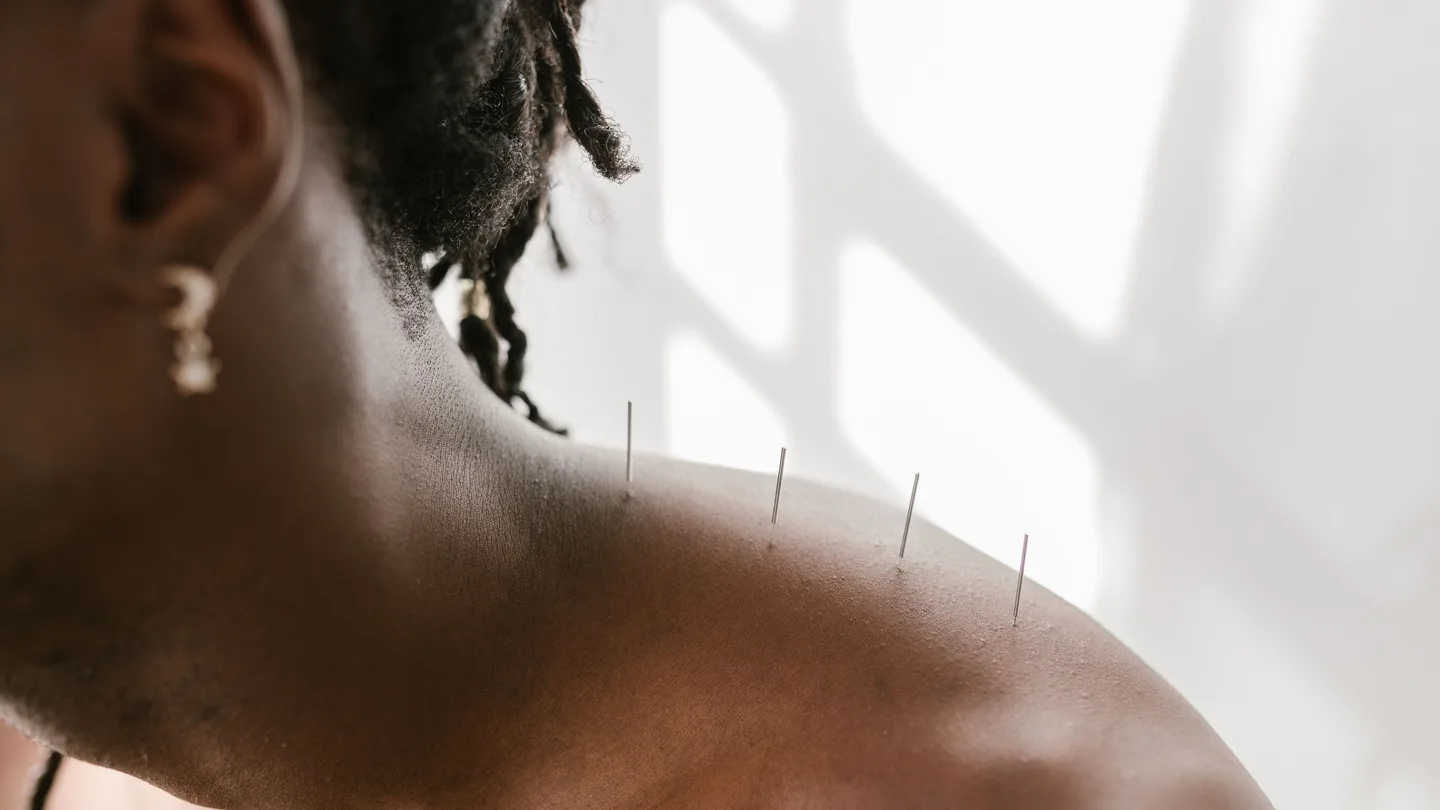 Thin needles placed around the shoulder muscles during treatment
